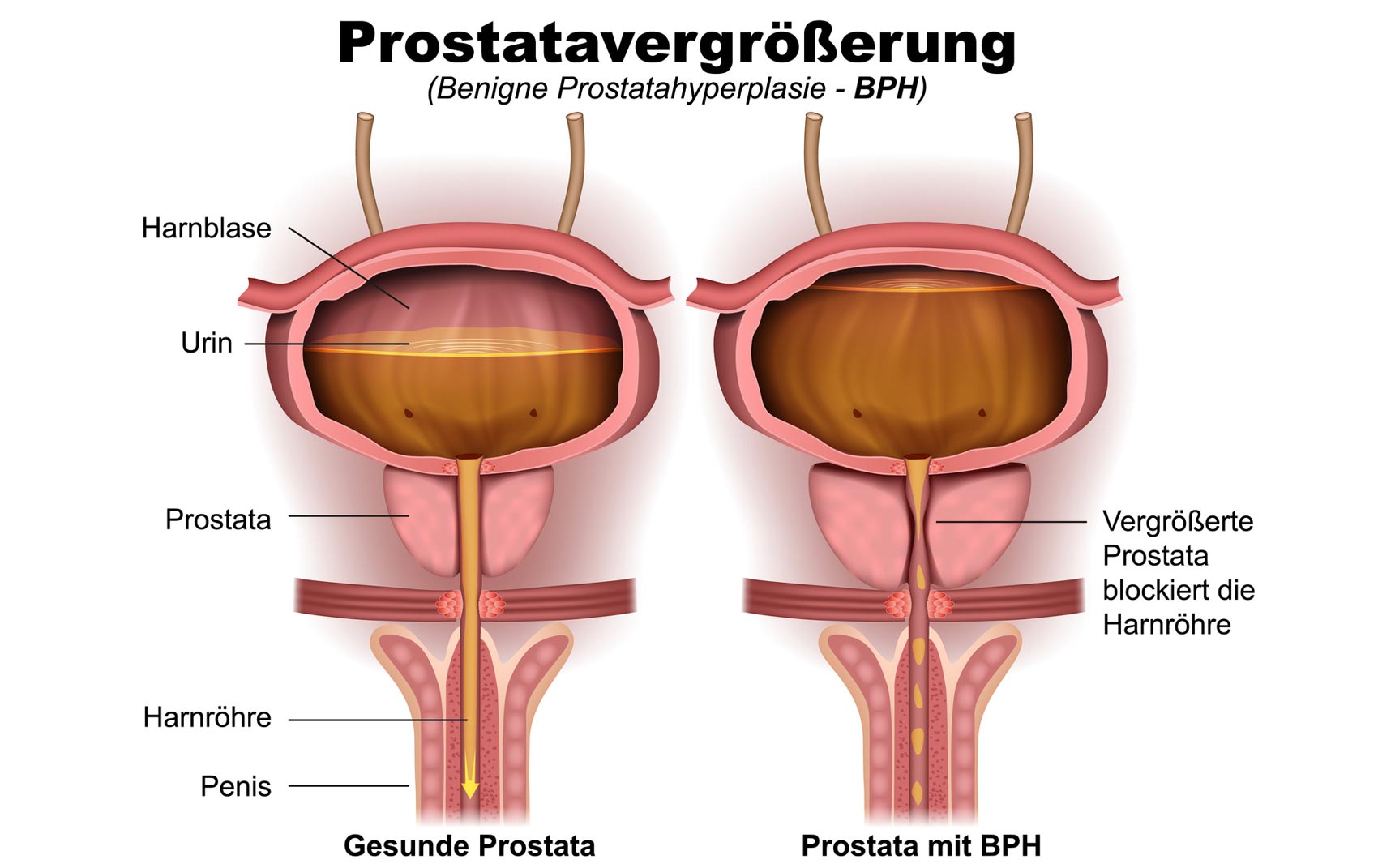 Prostatavergroesserung Prostata