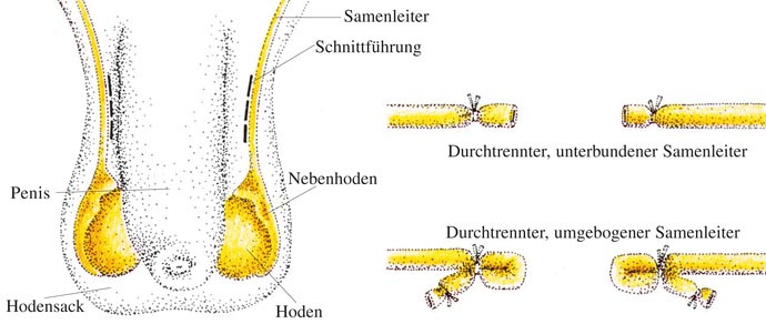 Methode der Empfängnisverhütung beim Mann